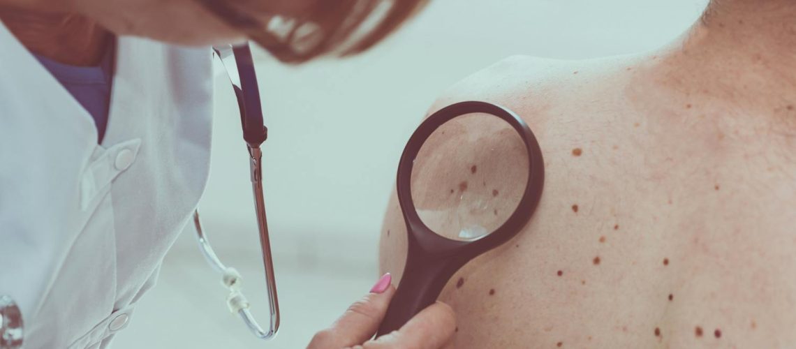 Cancer de la peau : quels sont les symptômes ?